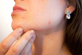 Bệnh da liễu gây mất thẩm mỹ và ảnh hưởng đến cuộc sống hằng ngày.